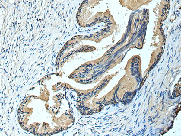 FCRLA Antibody - Immunohistochemistry of paraffin-embedded Human prost ate cancer tissue  using FCRLA Polyclonal Antibody at dilution of 1:90(×200)