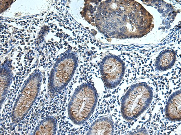 FCRLA Antibody - Immunohistochemistry of paraffin-embedded Human colorectal cancer tissue  using FCRLA Polyclonal Antibody at dilution of 1:80(×200)