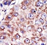FDFT1 / Squalene Synthase Antibody - Formalin-fixed and paraffin-embedded human cancer tissue reacted with the primary antibody, which was peroxidase-conjugated to the secondary antibody, followed by DAB staining. This data demonstrates the use of this antibody for immunohistochemistry; clinical relevance has not been evaluated. BC = breast carcinoma; HC = hepatocarcinoma.