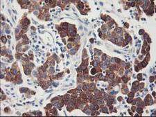 FDFT1 / Squalene Synthase Antibody - IHC of paraffin-embedded Carcinoma of Human lung tissue using anti-FDFT1 mouse monoclonal antibody.