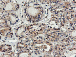 FDFT1 / Squalene Synthase Antibody - IHC of paraffin-embedded Carcinoma of Human thyroid tissue using anti-FDFT1 mouse monoclonal antibody.