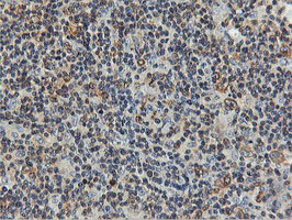 FDFT1 / Squalene Synthase Antibody - IHC of paraffin-embedded Human lymphoma tissue using anti-FDFT1 mouse monoclonal antibody.