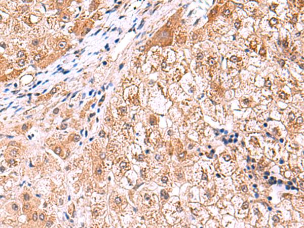 FDFT1 / Squalene Synthase Antibody - Immunohistochemistry of paraffin-embedded Human liver cancer tissue  using FDFT1 Polyclonal Antibody at dilution of 1:75(×200)
