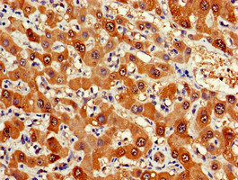 FDPS Antibody - Immunohistochemistry of paraffin-embedded human liver cancer at dilution of 1:100