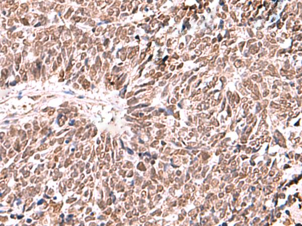 FDPS Antibody - Immunohistochemistry of paraffin-embedded Human lung cancer tissue  using FDPS Polyclonal Antibody at dilution of 1:60(×200)