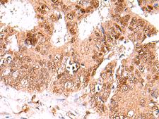 FDPS Antibody - Immunohistochemistry of paraffin-embedded Human colorectal cancer tissue  using FDPS Polyclonal Antibody at dilution of 1:60(×200)