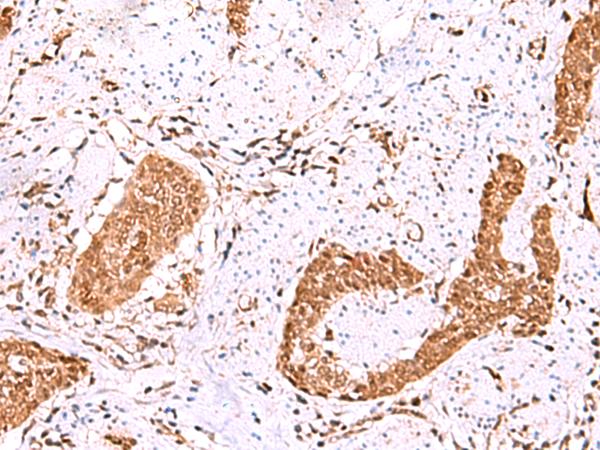 FDPS Antibody - Immunohistochemistry of paraffin-embedded Human esophagus cancer tissue  using FDPS Polyclonal Antibody at dilution of 1:60(×200)