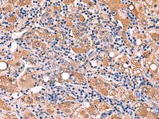 FDXR Antibody - Immunohistochemistry of paraffin-embedded Human liver cancer tissue  using FDXR Polyclonal Antibody at dilution of 1:110(×200)