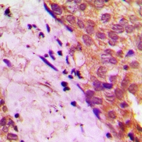 FE65L1 / APBB2 Antibody - Immunohistochemical analysis of APBB2 staining in human prostate cancer formalin fixed paraffin embedded tissue section. The section was pre-treated using heat mediated antigen retrieval with sodium citrate buffer (pH 6.0). The section was then incubated with the antibody at room temperature and detected with HRP and DAB as chromogen. The section was then counterstained with hematoxylin and mounted with DPX.