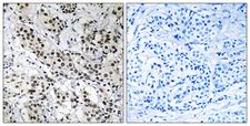FE65L1 / APBB2 Antibody - Peptide - + Immunohistochemistry analysis of paraffin-embedded human breast carcinoma tissue using APBB2 antibody.