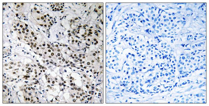 FE65L1 / APBB2 Antibody - Peptide - + Immunohistochemistry analysis of paraffin-embedded human breast carcinoma tissue using APBB2 antibody.