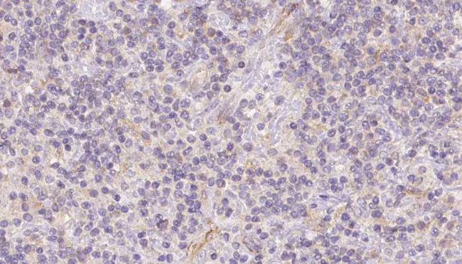 FECH / Ferrochelatase Antibody - 1:100 staining human lymph carcinoma tissue by IHC-P. The sample was formaldehyde fixed and a heat mediated antigen retrieval step in citrate buffer was performed. The sample was then blocked and incubated with the antibody for 1.5 hours at 22°C. An HRP conjugated goat anti-rabbit antibody was used as the secondary.