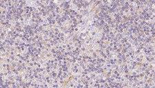 FECH / Ferrochelatase Antibody - 1:100 staining human lymph carcinoma tissue by IHC-P. The sample was formaldehyde fixed and a heat mediated antigen retrieval step in citrate buffer was performed. The sample was then blocked and incubated with the antibody for 1.5 hours at 22°C. An HRP conjugated goat anti-rabbit antibody was used as the secondary.