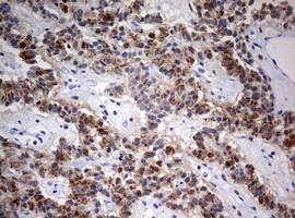 FEN1 Antibody - IHC of paraffin-embedded Carcinoma of Human pancreas tissue using anti-FEN1 mouse monoclonal antibody. (Heat-induced epitope retrieval by 10mM citric buffer, pH6.0, 120°C for 3min).