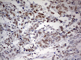 FEN1 Antibody - IHC of paraffin-embedded Adenocarcinoma of Human endometrium tissue using anti-FEN1 mouse monoclonal antibody. (Heat-induced epitope retrieval by 10mM citric buffer, pH6.0, 120°C for 3min).