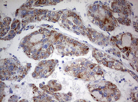 FEN1 Antibody - IHC of paraffin-embedded Carcinoma of Human liver tissue using anti-FEN1 mouse monoclonal antibody. (Heat-induced epitope retrieval by 10mM citric buffer, pH6.0, 120°C for 3min).