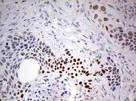 FEN1 Antibody - IHC of paraffin-embedded Carcinoma of Human lung tissue using anti-FEN1 mouse monoclonal antibody. (Heat-induced epitope retrieval by 10mM citric buffer, pH6.0, 120°C for 3min).