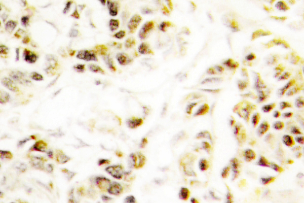 FEN1 Antibody - IHC of FEN-1 (A119) pAb in paraffin-embedded human breast carcinoma tissue.