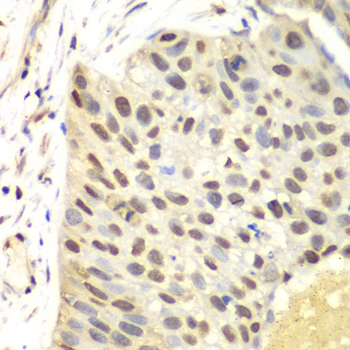 FEN1 Antibody - Immunohistochemistry of formalin-fixed paraffin-embedded (FFPE) human lung cancer using FEN1 antibody at dilution of 1:100 (40x magnification).