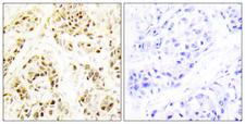 FEN1 Antibody - Peptide - + Immunohistochemistry analysis of paraffin-embedded human breast carcinoma tissue using FEN1 antibody.