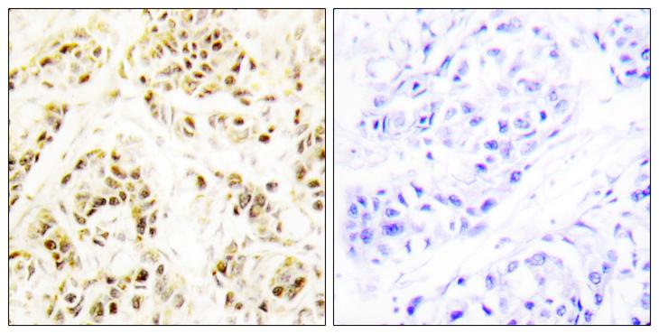 FEN1 Antibody - Peptide - + Immunohistochemistry analysis of paraffin-embedded human breast carcinoma tissue using FEN1 antibody.