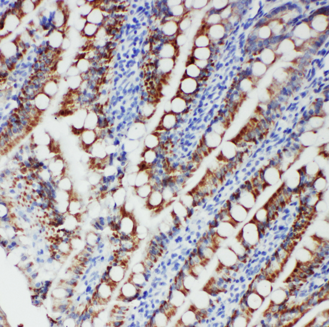 FER Antibody - FER antibody. IHC(P): Human Intestinal Cancer Tissue.