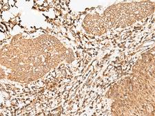 FER Antibody - Immunohistochemistry of paraffin-embedded Human esophagus cancer tissue  using FER Polyclonal Antibody at dilution of 1:90(×200)