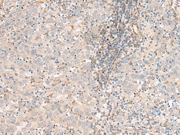 FER Antibody - Immunohistochemistry of paraffin-embedded Human cervical cancer tissue  using FER Polyclonal Antibody at dilution of 1:80(×200)