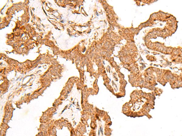 FER Antibody - Immunohistochemistry of paraffin-embedded Human thyroid cancer tissue  using FER Polyclonal Antibody at dilution of 1:80(×200)