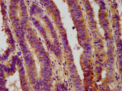 FERMT1 / Kindlin Antibody - Immunohistochemistry image at a dilution of 1:800 and staining in paraffin-embedded human colon cancer performed on a Leica BondTM system. After dewaxing and hydration, antigen retrieval was mediated by high pressure in a citrate buffer (pH 6.0) . Section was blocked with 10% normal goat serum 30min at RT. Then primary antibody (1% BSA) was incubated at 4 °C overnight. The primary is detected by a biotinylated secondary antibody and visualized using an HRP conjugated SP system.