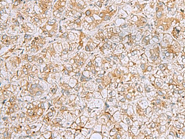 FERMT1 / Kindlin Antibody - Immunohistochemistry of paraffin-embedded Human liver cancer tissue  using FERMT1 Polyclonal Antibody at dilution of 1:30(×200)