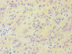 FES Antibody - Immunohistochemistry of paraffin-embedded human liver cancer using antibody at 1:100 dilution.
