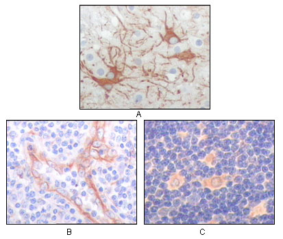 FES Antibody - IHC of paraffin-embedded human cerebrum tumor (A), endothelium of vessel (B), lymphocyte of thymus(C), showing cytoplasmic localization using FES mouse monoclonal antibody with DAB staining.
