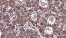 FFAR2 / GPR43 Antibody - 1:100 staining human liver carcinoma tissues by IHC-P. The sample was formaldehyde fixed and a heat mediated antigen retrieval step in citrate buffer was performed. The sample was then blocked and incubated with the antibody for 1.5 hours at 22°C. An HRP conjugated goat anti-rabbit antibody was used as the secondary.