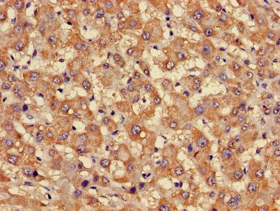 FFAR3 / GPR41 Antibody - Immunohistochemistry of paraffin-embedded human liver cancer using FFAR3 Antibody at dilution of 1:100