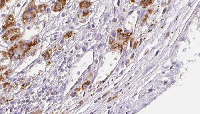 FFAR3 / GPR41 Antibody - 1:100 staining human liver carcinoma tissues by IHC-P. The sample was formaldehyde fixed and a heat mediated antigen retrieval step in citrate buffer was performed. The sample was then blocked and incubated with the antibody for 1.5 hours at 22°C. An HRP conjugated goat anti-rabbit antibody was used as the secondary.