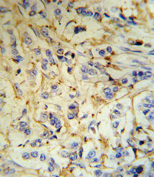 FGA / Fibrinogen Alpha Antibody - FGA Antibody (RB18707) IHC of formalin-fixed and paraffin-embedded human breast carcinoma tissue followed by peroxidase-conjugated secondary antibody and DAB staining.