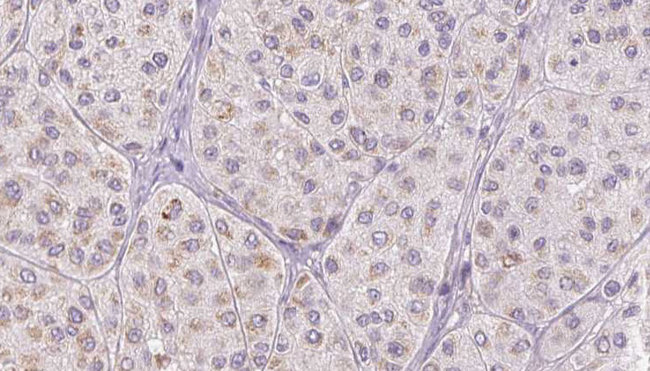 FGA / Fibrinogen Alpha Antibody - 1:100 staining human Melanoma tissue by IHC-P. The sample was formaldehyde fixed and a heat mediated antigen retrieval step in citrate buffer was performed. The sample was then blocked and incubated with the antibody for 1.5 hours at 22°C. An HRP conjugated goat anti-rabbit antibody was used as the secondary.