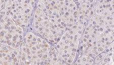 FGA / Fibrinogen Alpha Antibody - 1:100 staining human Melanoma tissue by IHC-P. The sample was formaldehyde fixed and a heat mediated antigen retrieval step in citrate buffer was performed. The sample was then blocked and incubated with the antibody for 1.5 hours at 22°C. An HRP conjugated goat anti-rabbit antibody was used as the secondary.