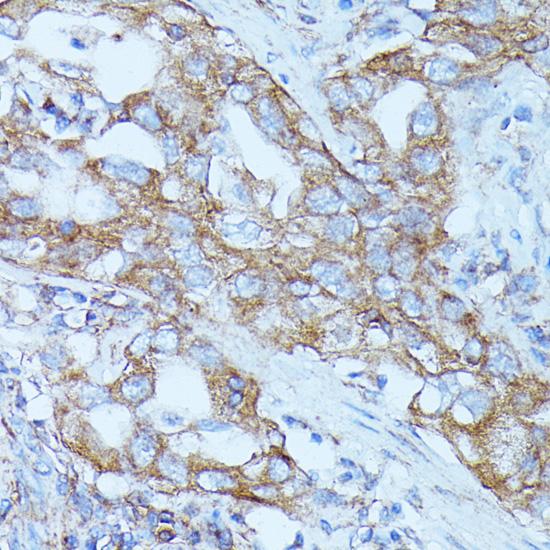 FGD1 Antibody - Immunohistochemistry of paraffin-embedded Human lung cancer using FGD1 Polyclonal Antibody at dilution of 1:100 (40x lens).