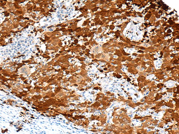 FGD3 Antibody - Immunohistochemistry of paraffin-embedded Human cervical cancer tissue  using FGD3 Polyclonal Antibody at dilution of 1:50(×200)