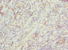 FGD5 Antibody - Immunohistochemistry of paraffin-embedded human bladder cancer at dilution 1:100