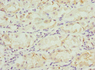 FGD5 Antibody - Immunohistochemistry of paraffin-embedded human gastric cancer at dilution 1:100