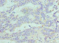FGF1 / Acidic FGF Antibody - Immunohistochemistry of paraffin-embedded human colon cancer using antibody at 1:100 dilution.