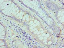 FGF1 / Acidic FGF Antibody - Immunohistochemistry of paraffin-embedded human colon cancer using antibody at 1:100 dilution.