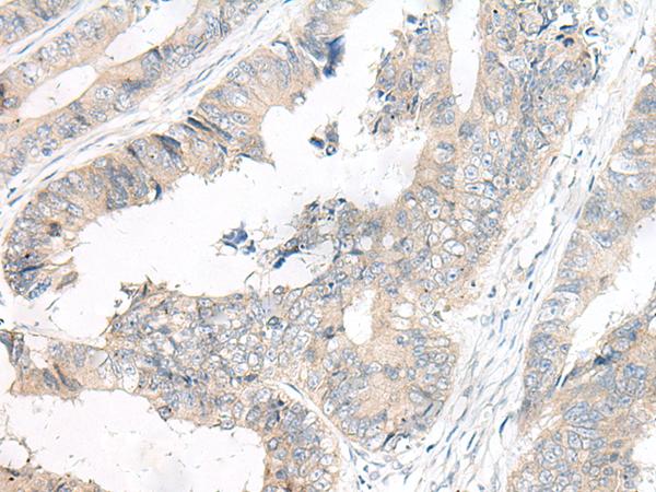 FGF10 Antibody - Immunohistochemistry of paraffin-embedded Human colorectal cancer tissue  using FGF10 Polyclonal Antibody at dilution of 1:30(×200)
