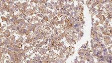 FGF11 / FGF-11 Antibody - 1:100 staining human Melanoma tissue by IHC-P. The sample was formaldehyde fixed and a heat mediated antigen retrieval step in citrate buffer was performed. The sample was then blocked and incubated with the antibody for 1.5 hours at 22°C. An HRP conjugated goat anti-rabbit antibody was used as the secondary.