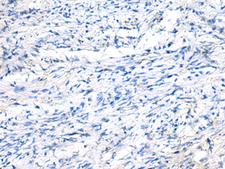 FGF11 / FGF-11 Antibody - Immunohistochemistry of paraffin-embedded Human ovarian cancer tissue  using FGF11 Polyclonal Antibody at dilution of 1:50(×200)