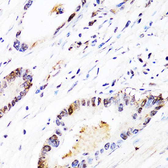 FGF12 Antibody - Immunohistochemistry of paraffin-embedded Human colon carcinoma using FGF12 Polyclonal Antibody at dilution of 1:150 (40x lens).