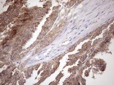 FGF13 Antibody - Immunohistochemical staining of paraffin-embedded Adenocarcinoma of Human ovary tissue using anti-FGF13 mouse monoclonal antibody. (Heat-induced epitope retrieval by 1mM EDTA in 10mM Tris buffer. (pH8.5) at 120 oC for 3 min. (1:150)